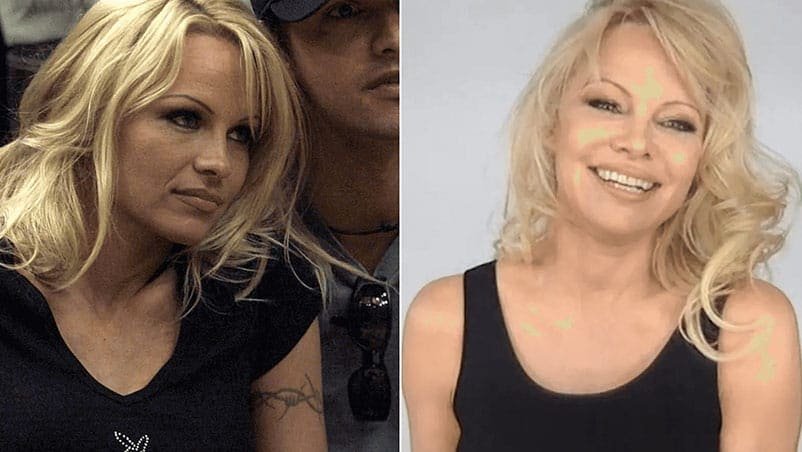 Pamela Anderson tattoo removal