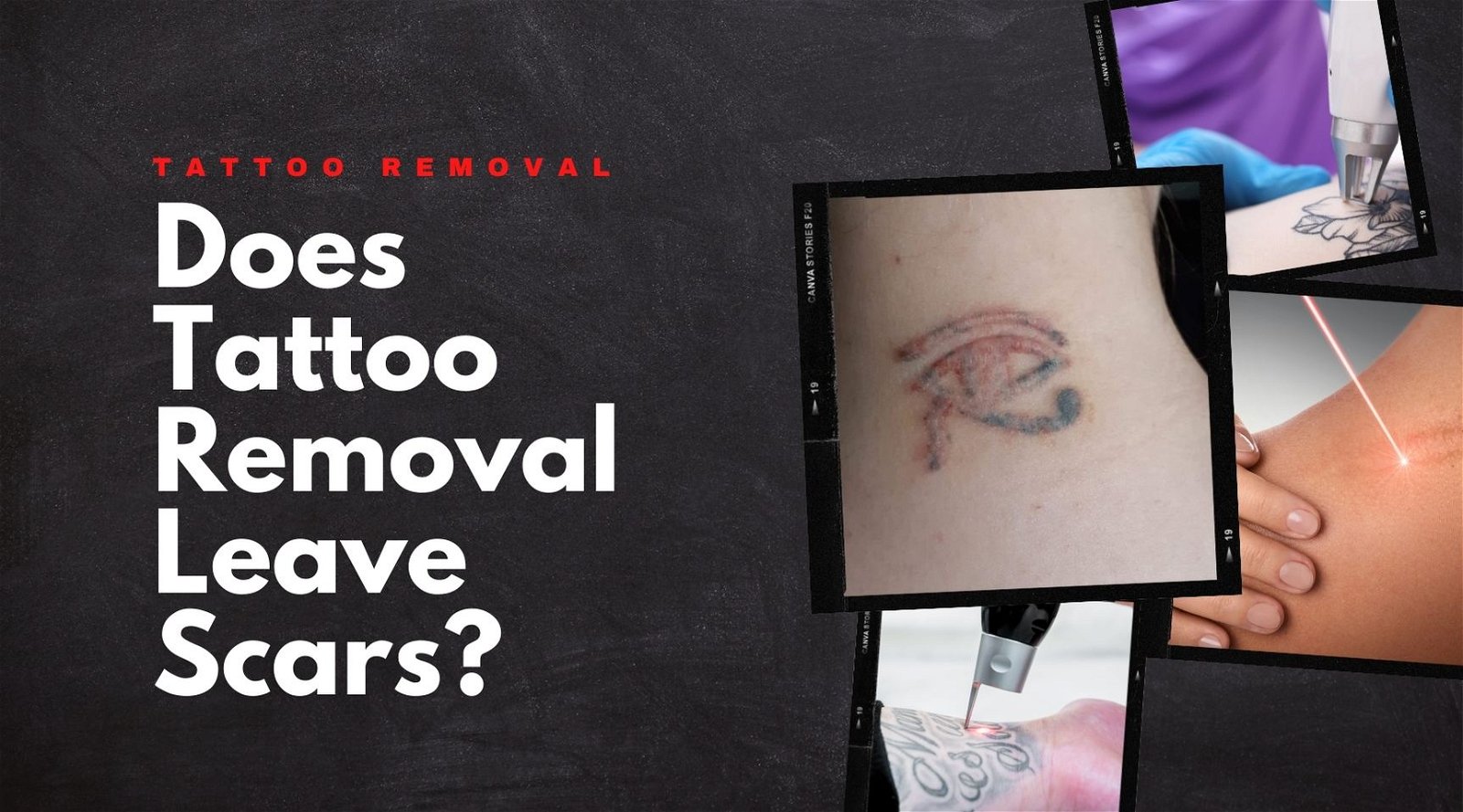 Tattoo Scarring Does Laser Tatto Removal Scar  Removery