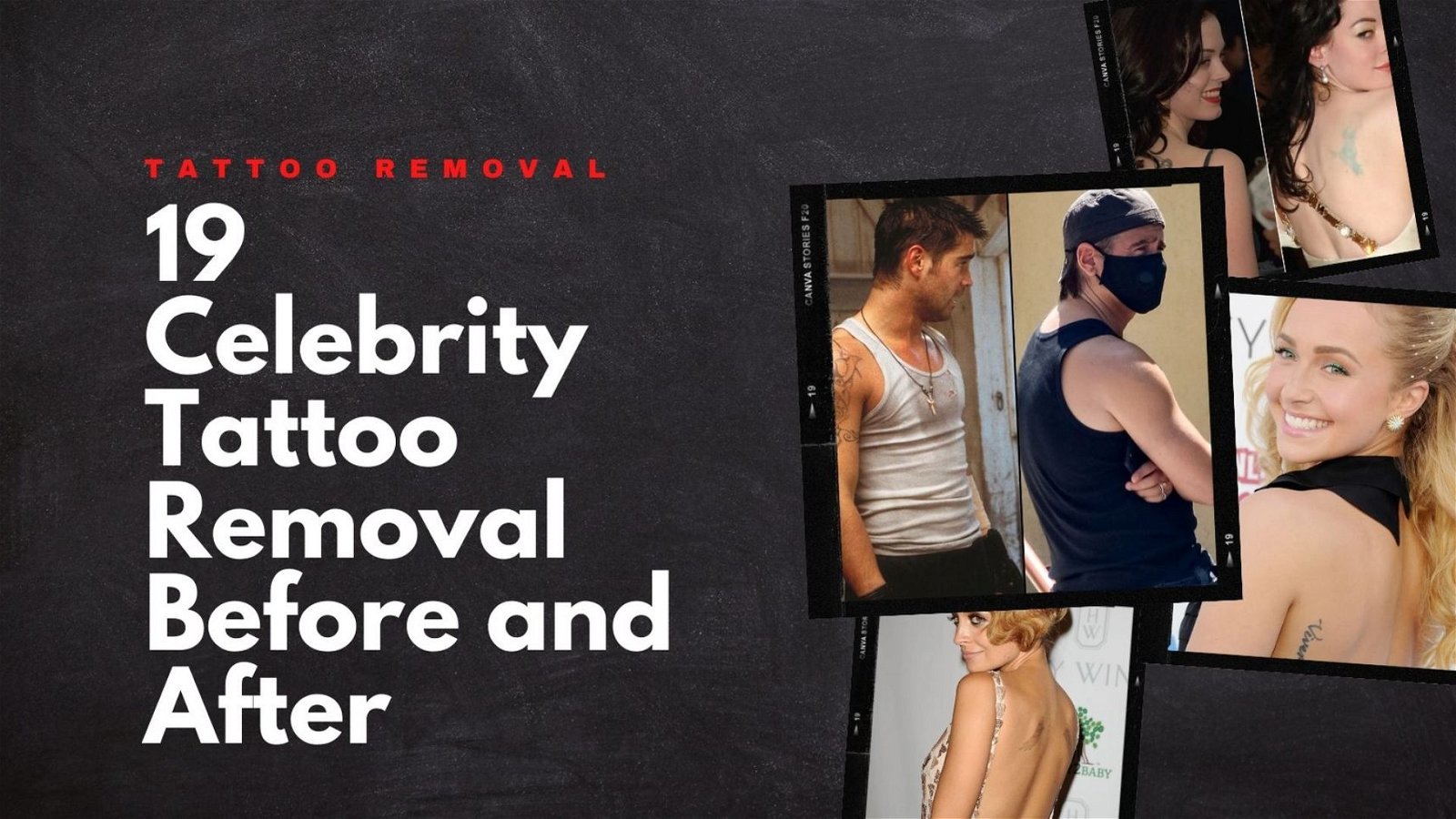 Discover more than 129 laser tattoo removal post care latest